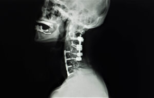 xray image of a neck with a acdf surgery