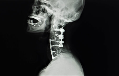 xray image of a neck with a acdf surgery